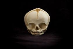 Osteo Cast Fetal Skull - 31 weeks BC-180